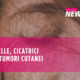 pelle, cicatrici e tumori cutanei